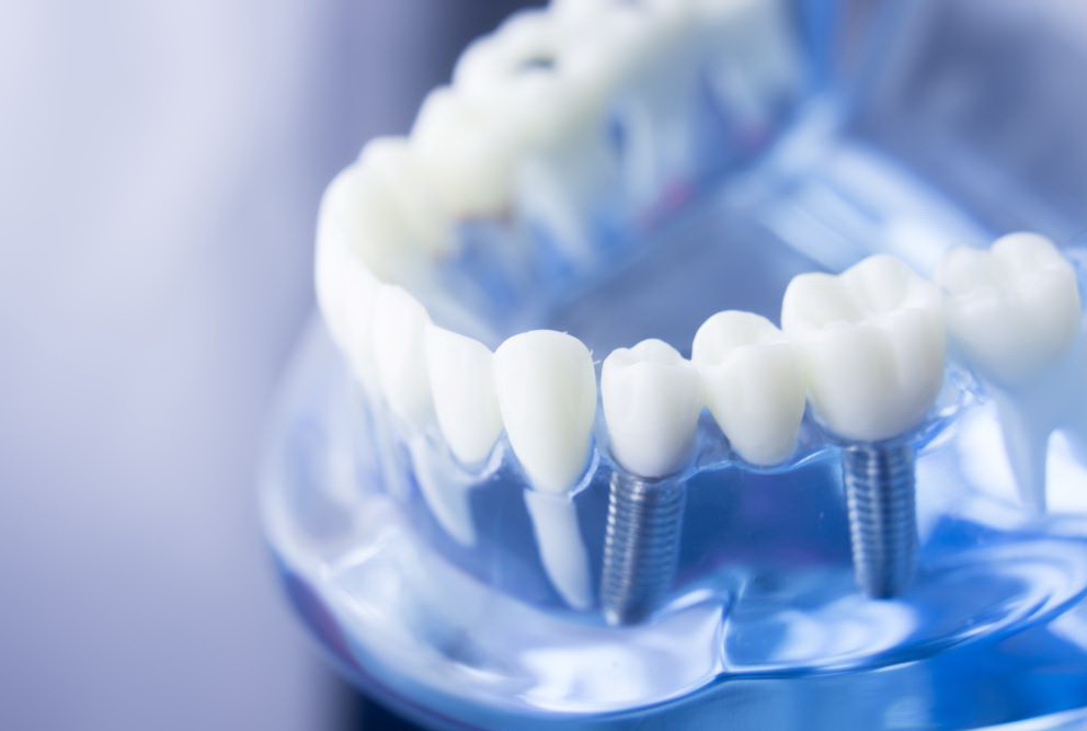 Современные методы протезирования зубов:...